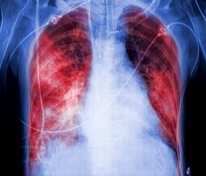 X-rays with lungs in red color, symbol of pneumonia